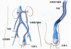 为什么会出现精索静脉曲张这样的情况