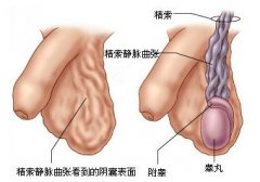 男性患有精索静脉曲张严重吗?
